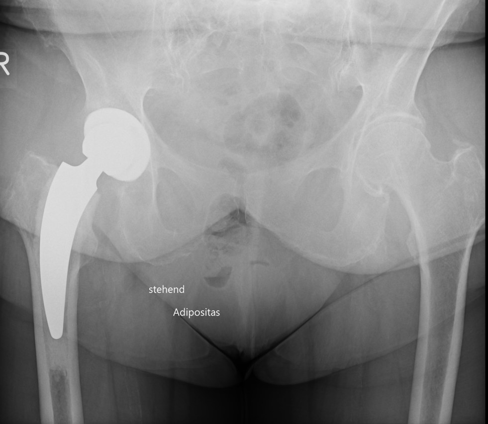 Hüftprothese zementiert, nachher Zementierte Hüftprothese nach der Operation, Röntgenbild, MainOrtho