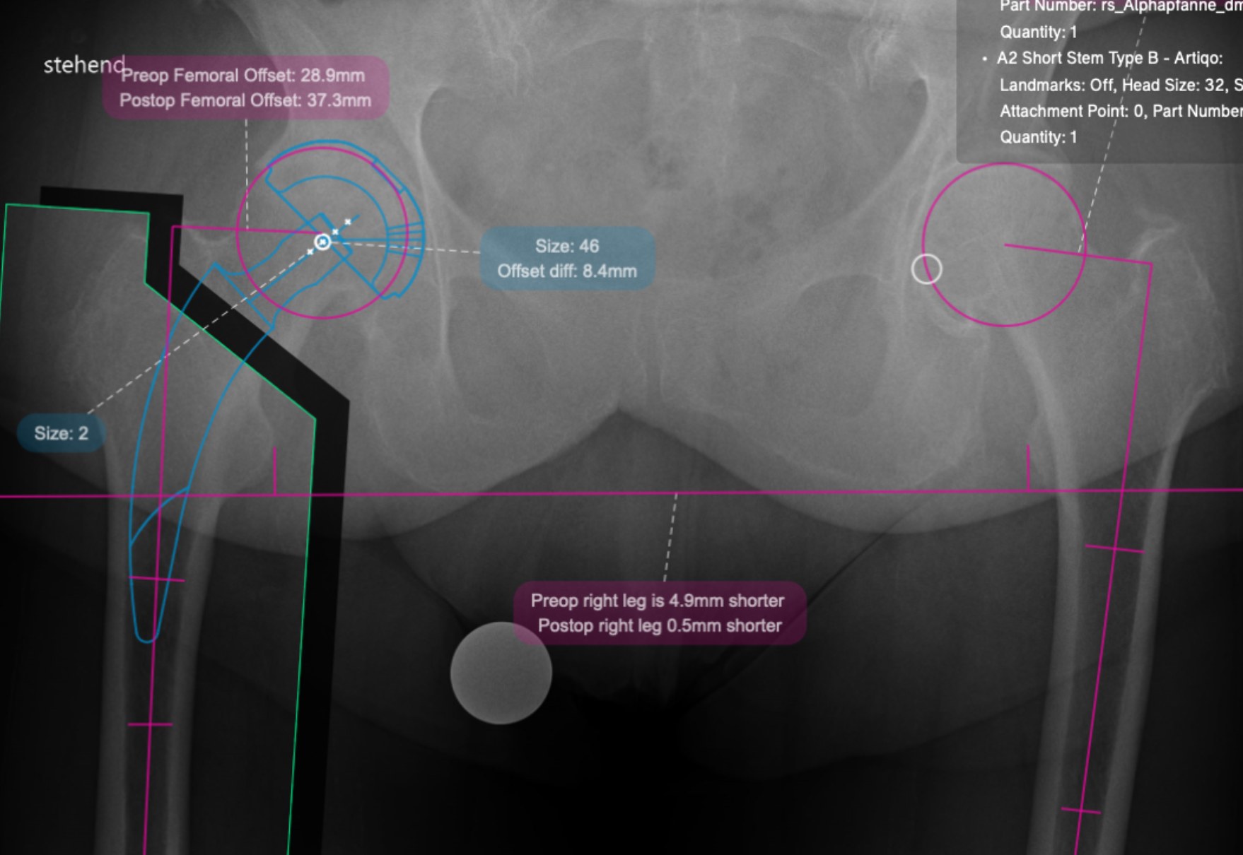 Hüftprothese zementiert, Planung Digitale Planung einer zementierten Hüftprothese am Röntgenbild, MainOrtho