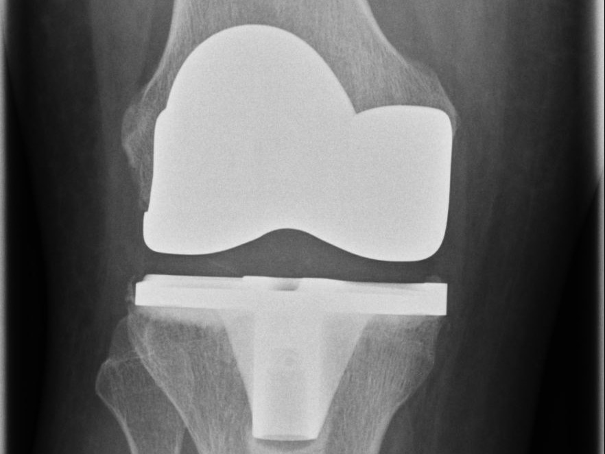 Knieprothese, Nachher Knieprothese nach der Operation, Röntgenbild, MainOrtho